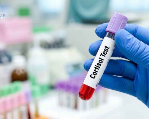 A cortisol blood test sample used to assess stress and metabolic health.